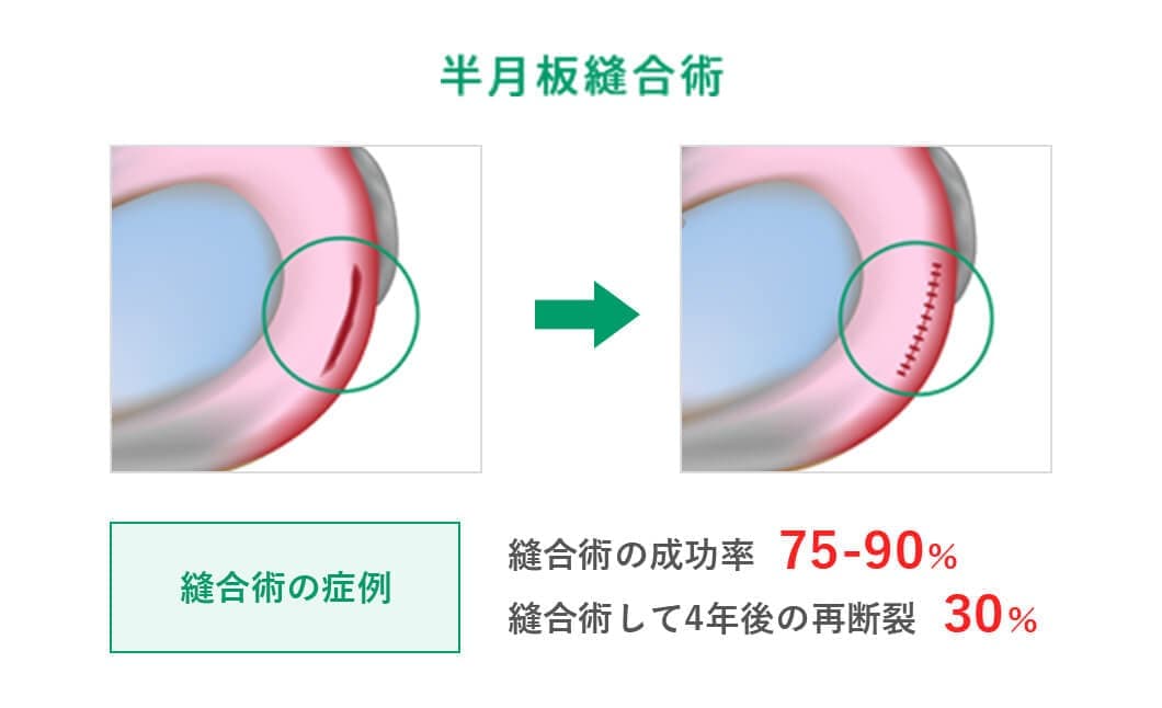 半月板損傷・半月板断裂に対する再生医療・幹細胞治療 | リペアセル