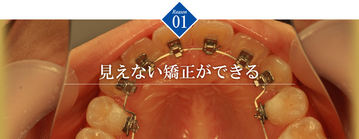 矯正専門医による部分矯正【ふかつ歯科・矯正歯科】