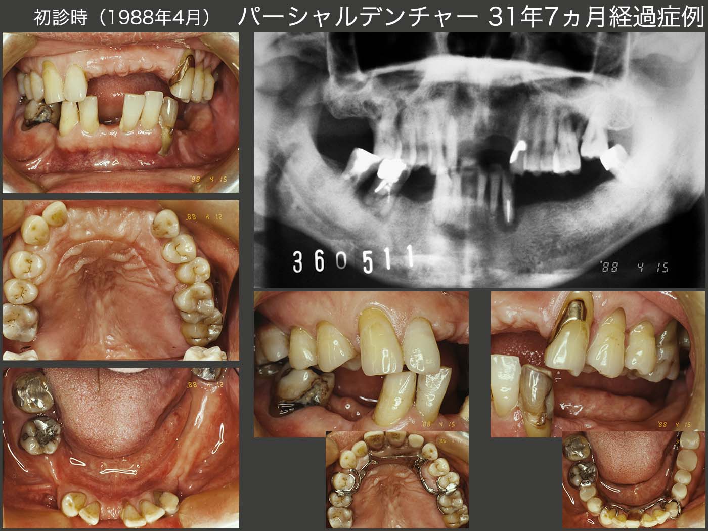21.パーシャルデンチャー31年7ヵ月経過症例 | 古屋歯科クリニック症例集