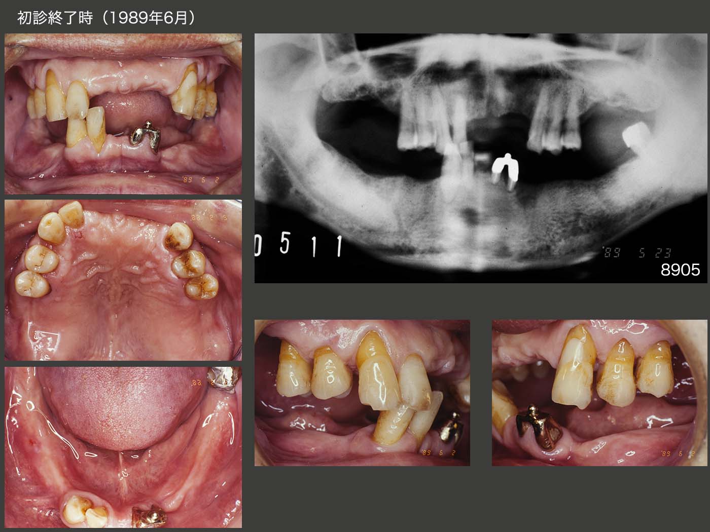 21.パーシャルデンチャー31年7ヵ月経過症例 | 古屋歯科クリニック症例集