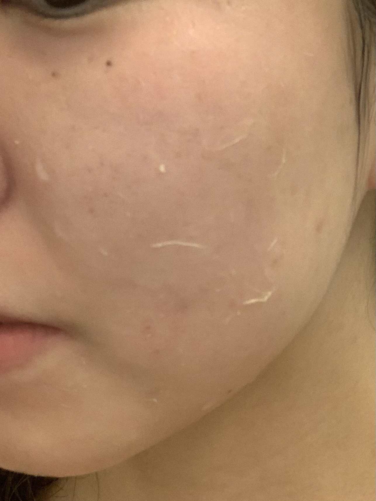 剥離ありのハーブピーリングの経過を徹底レビュー！効果やおすすめの