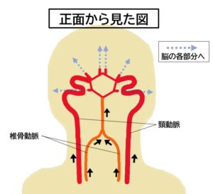 脳梗塞（脳動脈狭窄） Ischemic Stroke｜新大阪画像の森診断クリニック