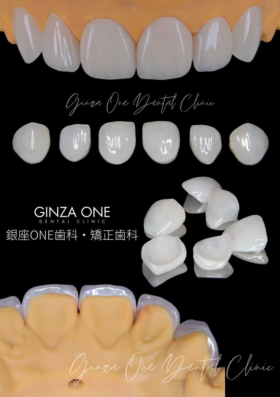 🦷 自然でバレない美しさ——ラミネートベニアの審美性｜銀座ONE歯科