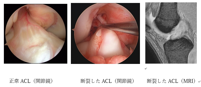 膝スポーツ人工関節センター | 群馬中央病院 | 地域医療機能推進機構