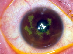 角膜感染症｜尼崎市宮内町にある萩原眼科クリニック