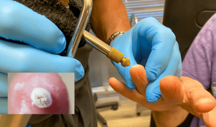 尋常性疣贅（ウイルス性疣贅） | 原宿駅前皮膚科 | 表参道 | 神宮前