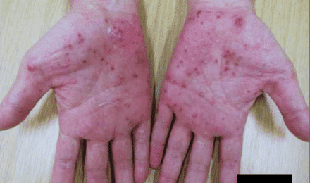 掌蹠膿疱症 | 原宿駅前皮膚科 | 表参道 | 神宮前 | 女性皮膚科専門医