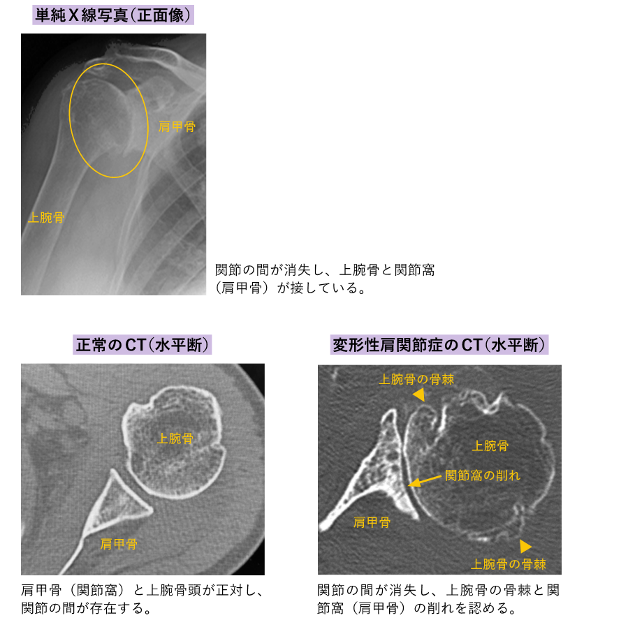 整形外科・スポーツ診療科｜変形性肩関節症｜順天堂大学医学部附属