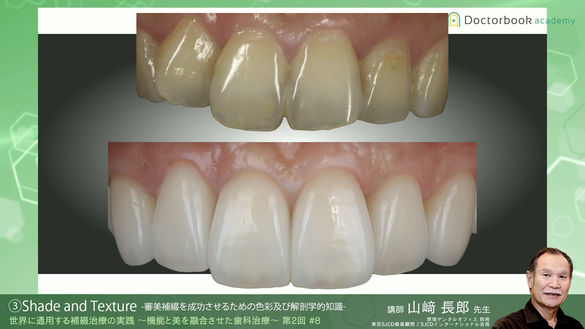 8 Shade and Texture -審美補綴を成功させるための色彩及び解剖学的