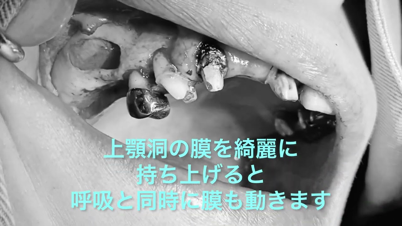 サイナスリフト（上顎洞底挙上術） - YouTube
