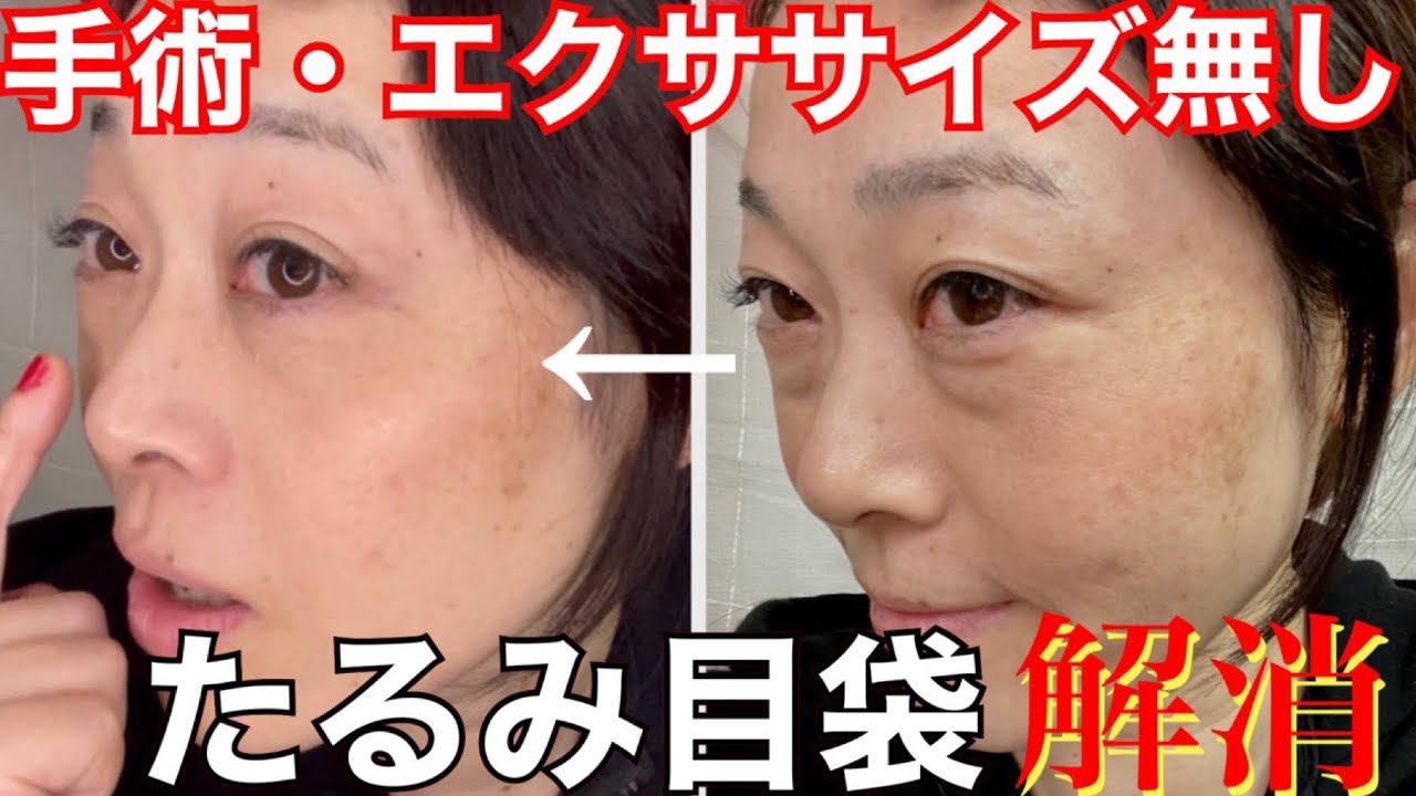 Sagging eye bags] Part 1: Is there really a way to do this?! A