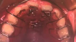 小児矯正 反対咬合・受け口の患者さま 床装置で治療 東京都 三鷹ハート