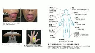 2020年版心アミロイドーシス診療ガイドライン - YouTube