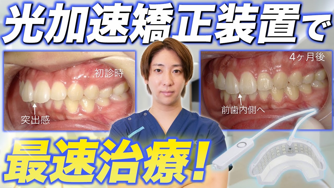 最短治療】短期間で歯並びを治す方法！【光加速矯正装置】 - YouTube