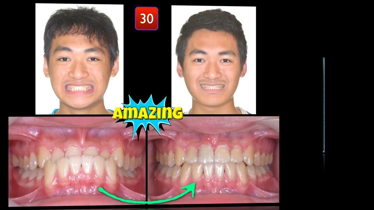 Solving Class III Malocclusion with Anterior X-bite｜【Chris Chang