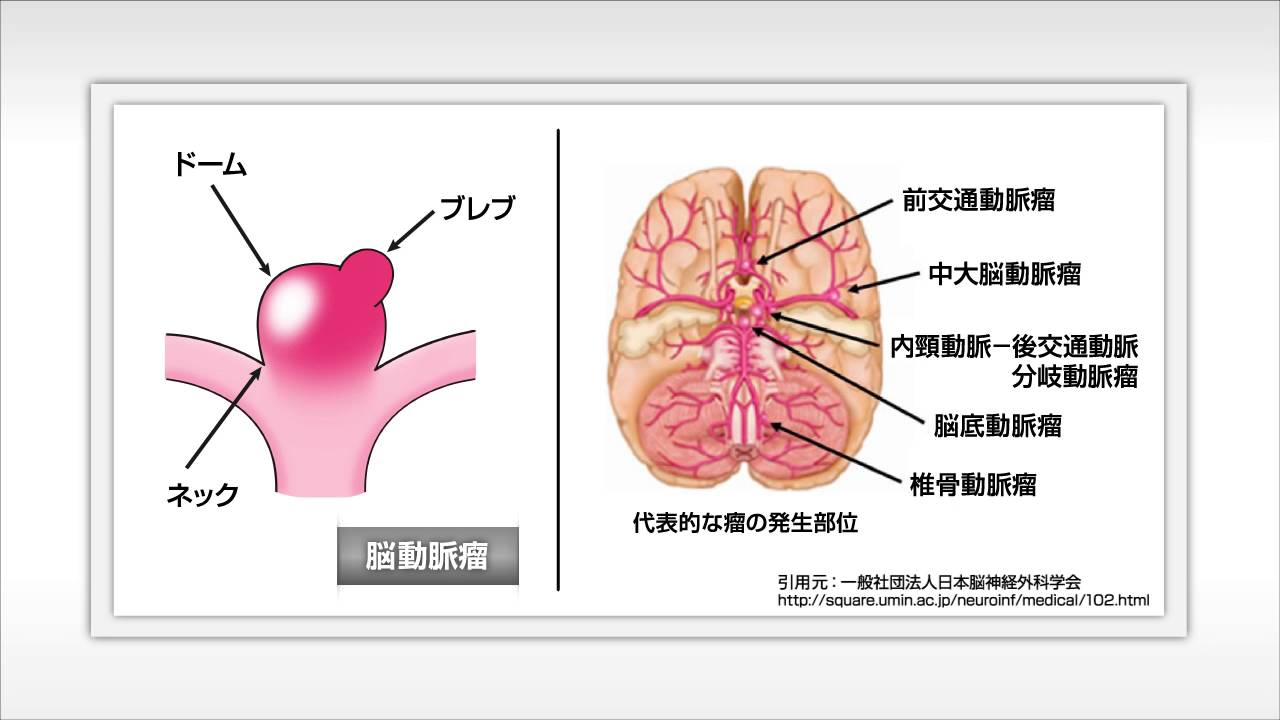 U-info｜未破裂脳動脈瘤とはなんでしょう？