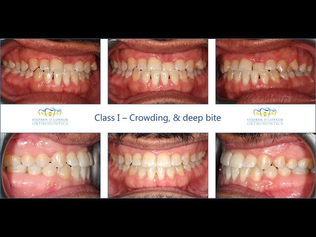 Class III occlusion - Labial ceramic braces - YouTube