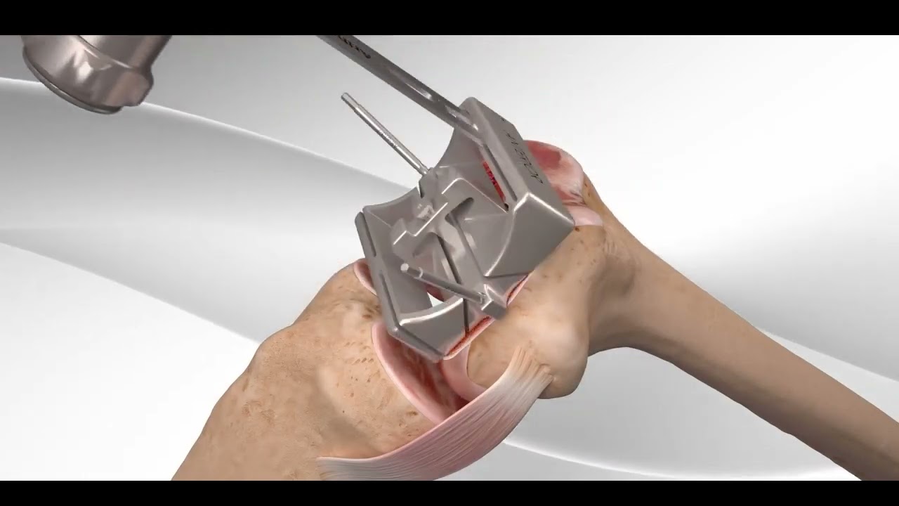 人工関節置換術 変形性膝関節症の手術 （TKA）膝OAの手術方法 - YouTube