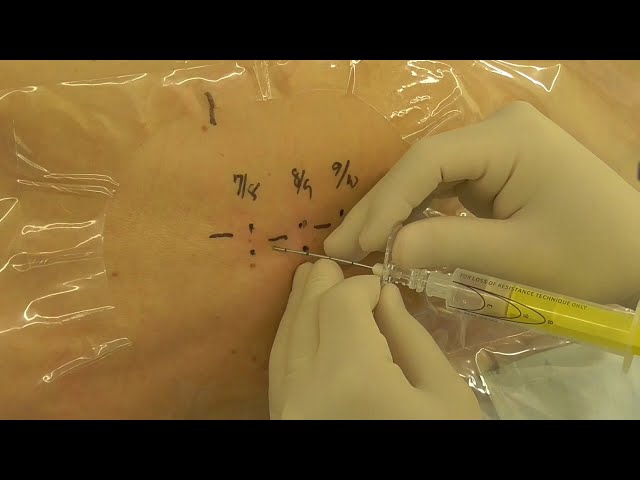 神経ブロック】硬膜外麻酔_Modified Laminar Approach(MLA) - YouTube