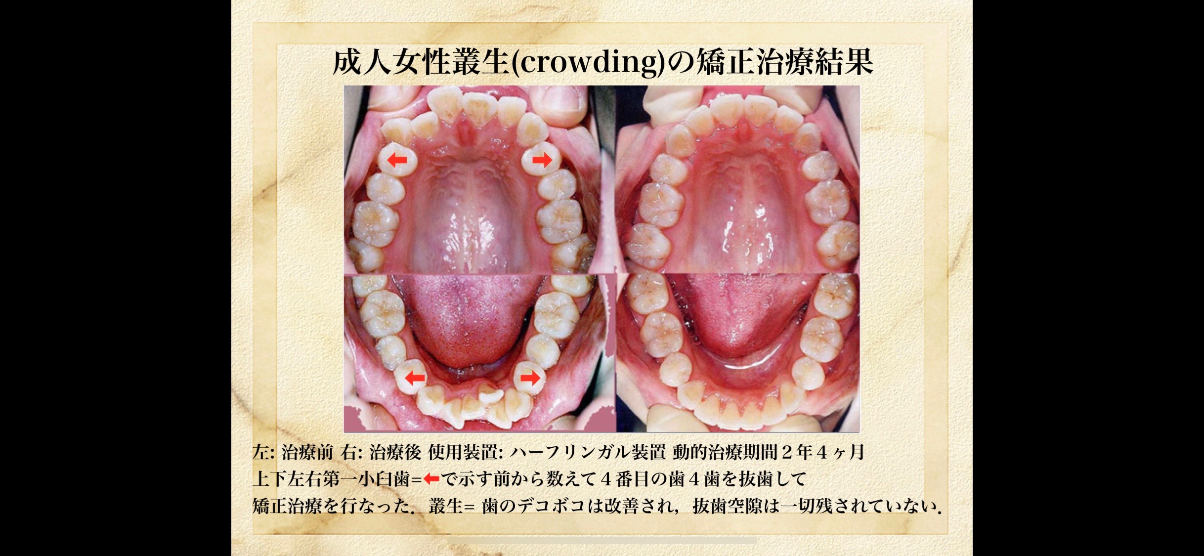 抜歯？ 非抜歯？・・・」 – 矯正歯科 鎌倉市 神奈川県 :日本歯科専門医