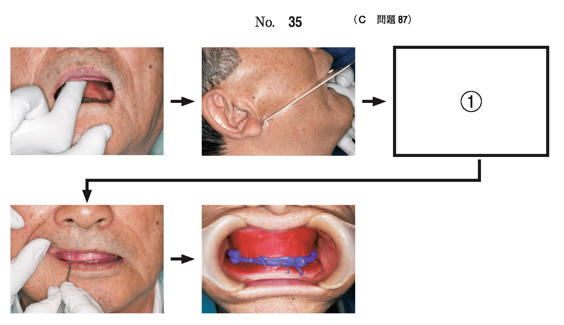 図解・咬合採得 図解・咬合採得 7 咬合採得①／垂直的顎