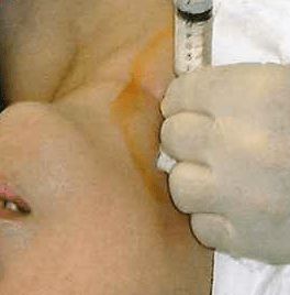 歯科麻酔学：局所麻酔薬中毒（計6問）【歯科医師国家試験】（2025年11