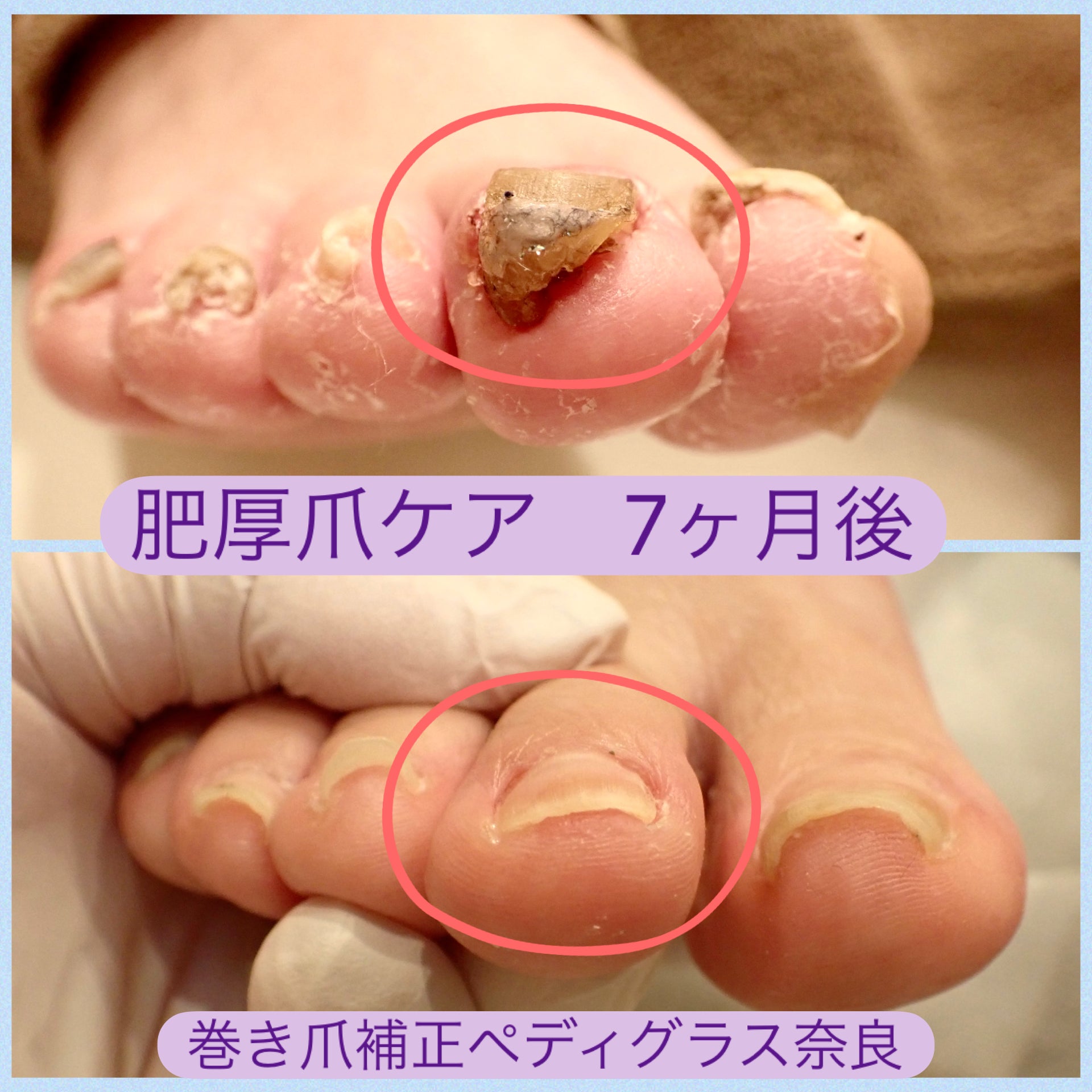 巻き爪補正ペディグラス奈良（奈良市富雄元町） | エキテン byGMO