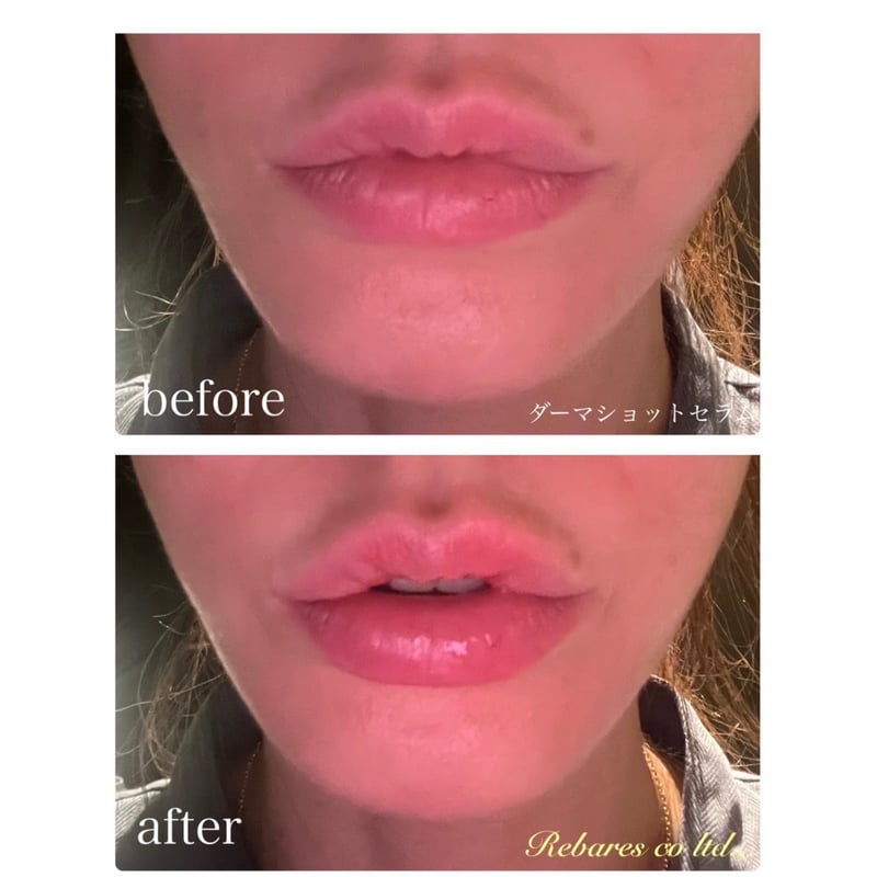 ダーマショットセラム 【正規取扱店】 | 【即日発送！】ダーマショット