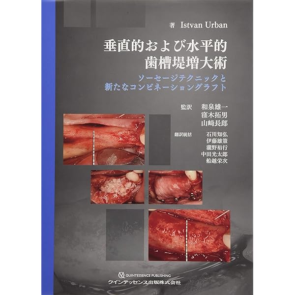 Amazon.co.jp: Vertical 2 骨造成: 垂直的および水平的歯槽堤増大術の