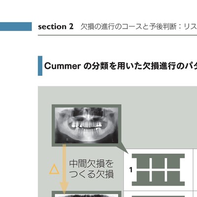 欠損歯列」の読み方,「欠損補綴」の設計