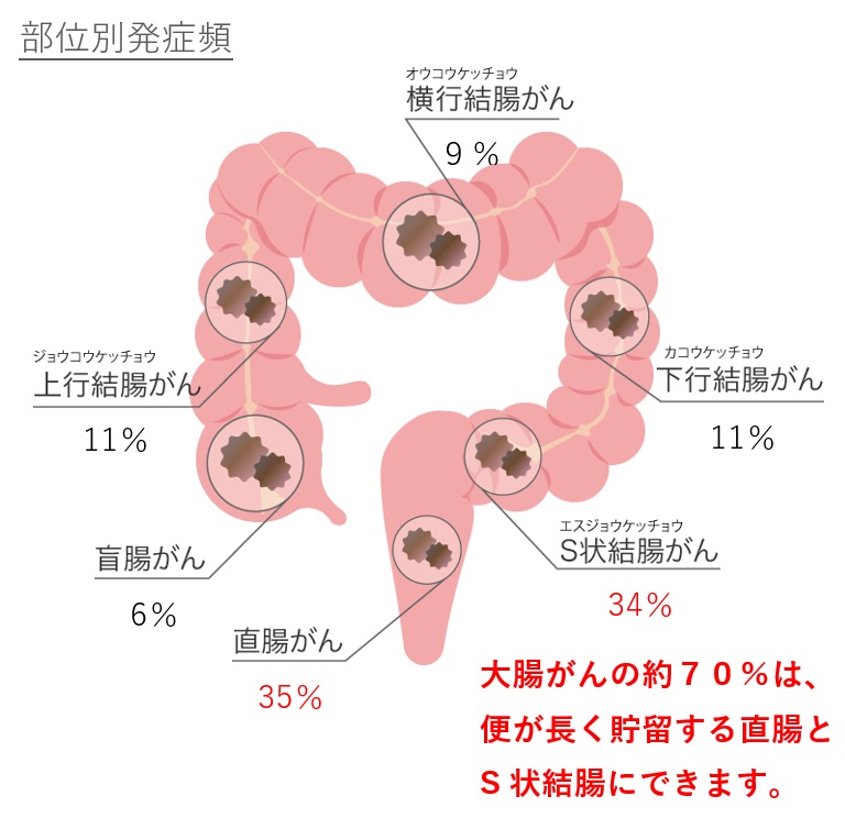 消化器腫瘍外科 絹笠祐介医師と大腸がんについて
