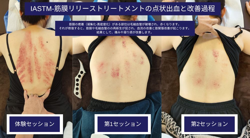 ISATM-筋膜リリースとは？ | 【IASTM筋膜リリース認定資格セミナー