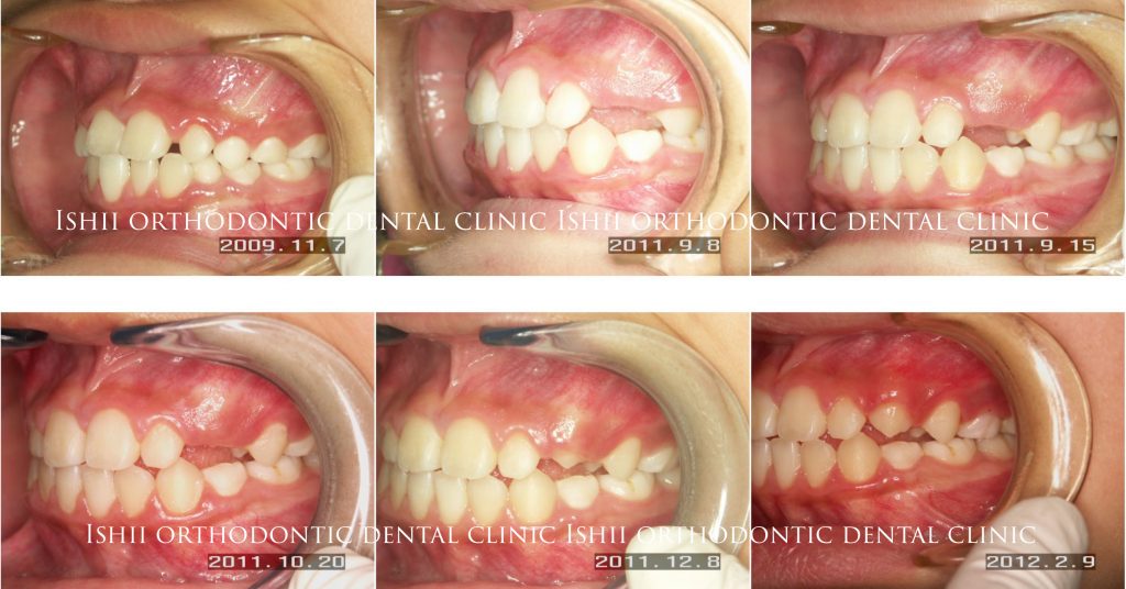 1期治療終了後の筋機能矯正装置によるコントロールの限界 album 248