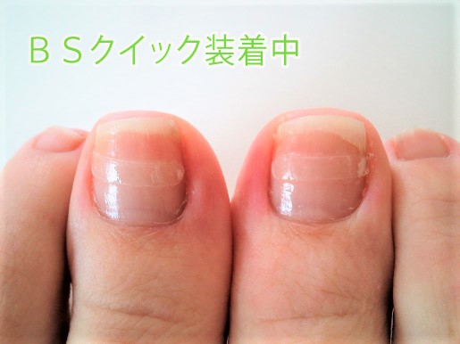 巻き爪矯正・ケアー名古屋市東区 | 泉2丁目接骨院