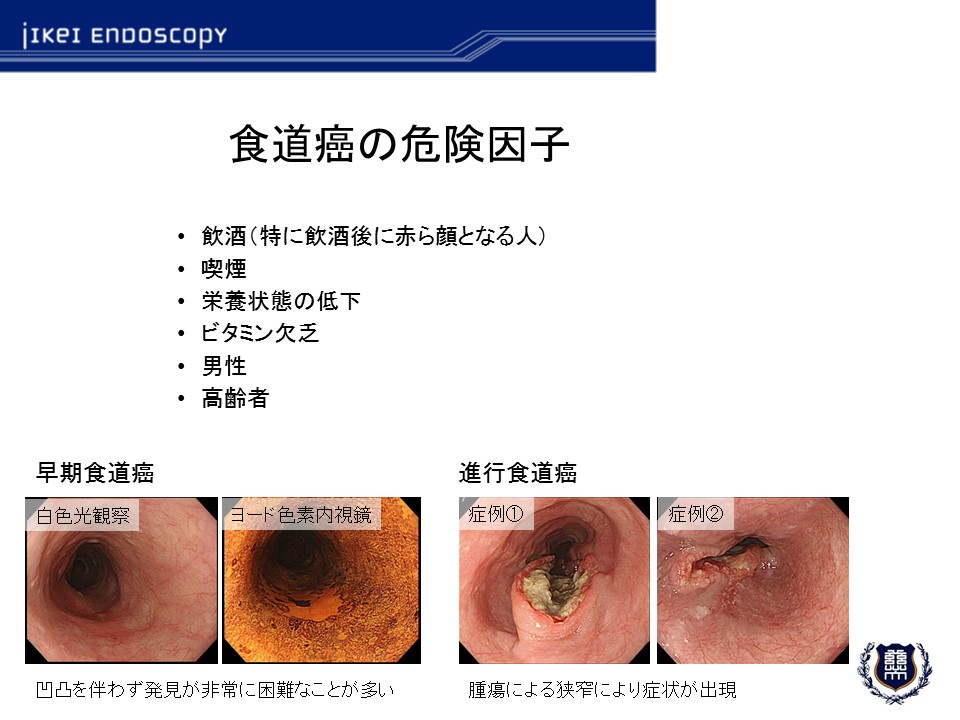 食道癌の早期発見と内視鏡診断・治療 | 東京慈恵会医科大学 内視鏡医学講座