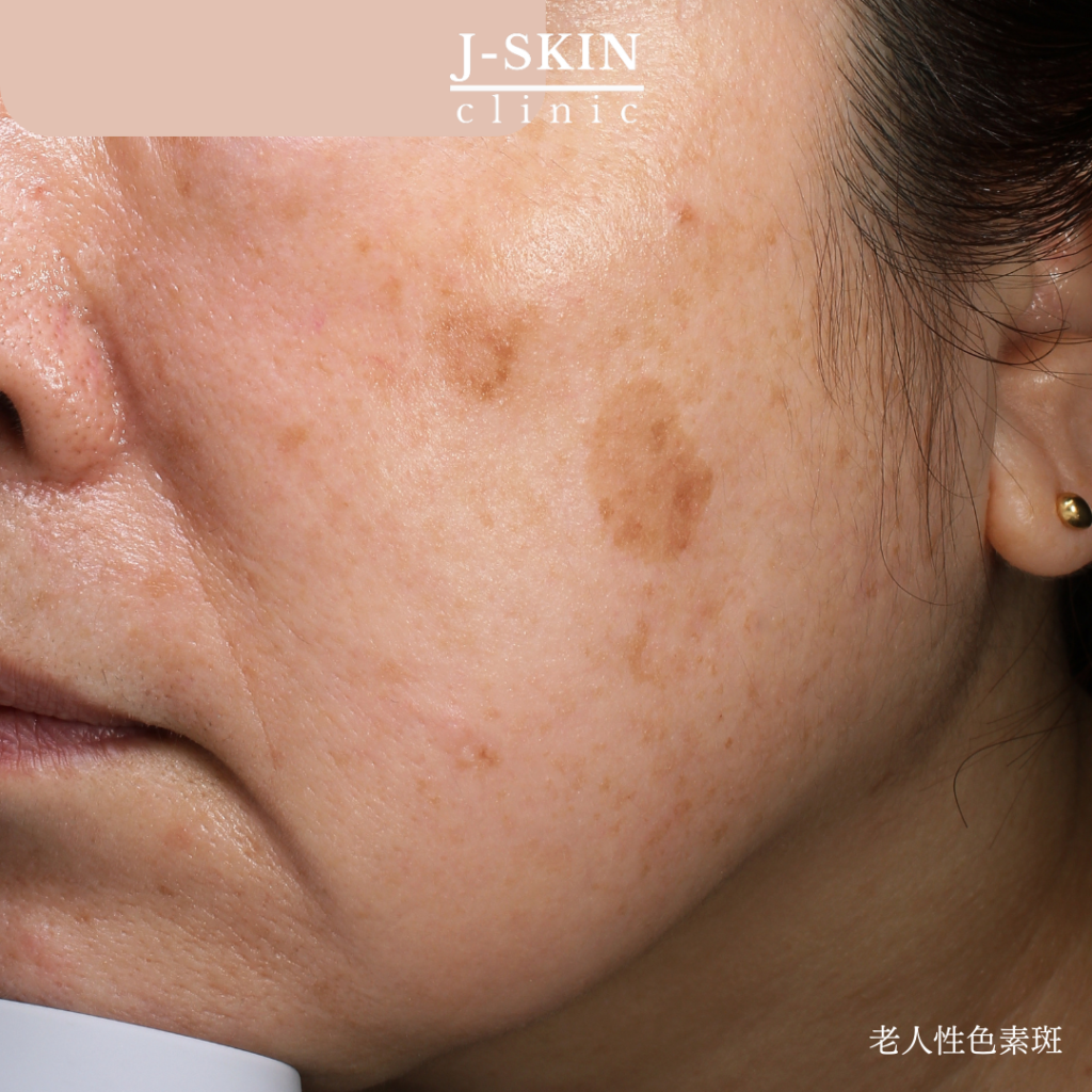 JSKINのくっきりしたシミ(老人性色素斑)治療 - JSKINクリニック東京