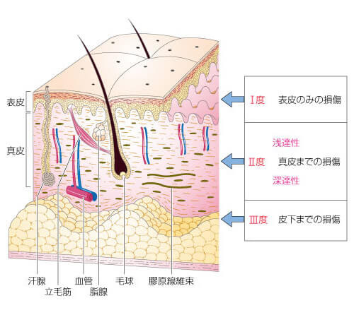 やけど（熱傷）｜日本形成外科学会