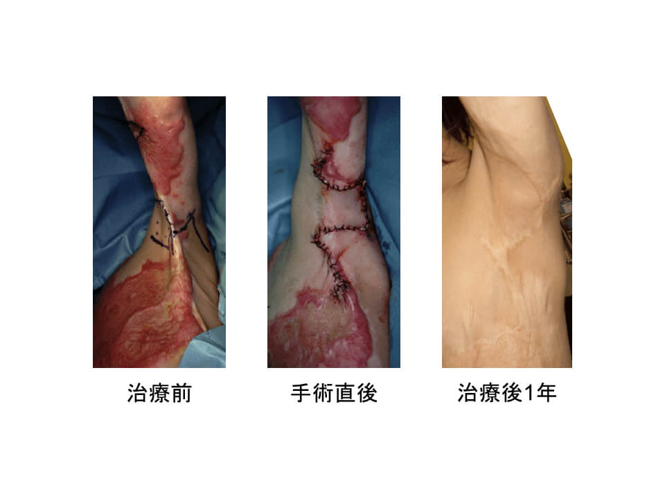 瘢痕拘縮｜日本形成外科学会