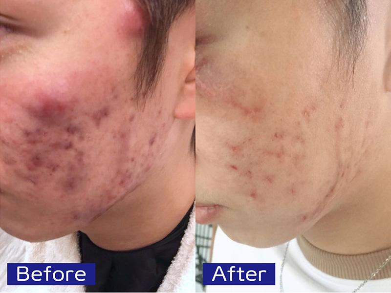 特集】ニキビでお悩みの方へ | 身体も心♥️も元気にするパワー