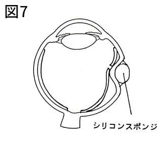 硝子体手術｜かくらい眼科｜相鉄線かしわ台駅