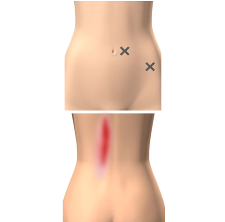 筋筋膜性疼痛症候群【MPS】痛みの引き金トリガーポイント｜痛みの事