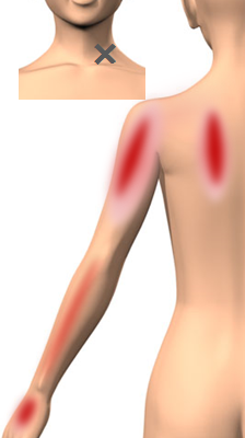 筋筋膜性疼痛症候群【MPS】痛みの引き金トリガーポイント｜痛みの事