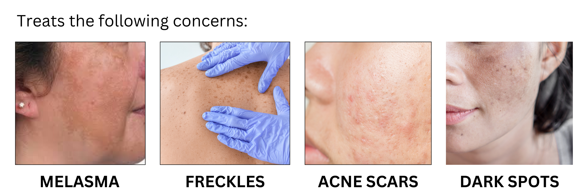 Kare Skin Health | Medical Skincare | Melapads Daily Exfoliating Pads