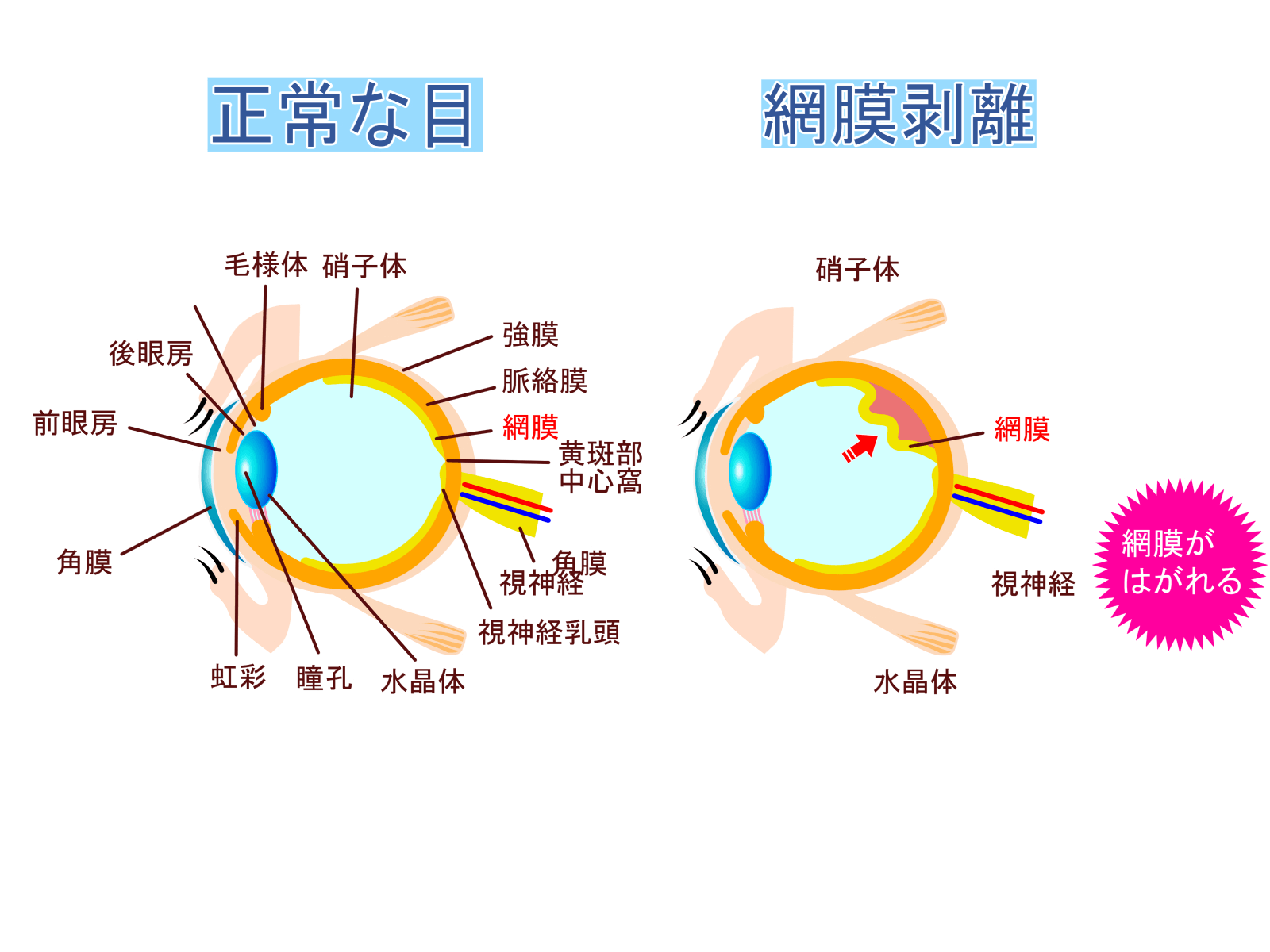 網膜剥離-早期発見が治療のカギ｜川越・鶴ヶ島の眼科 - 川越西眼科