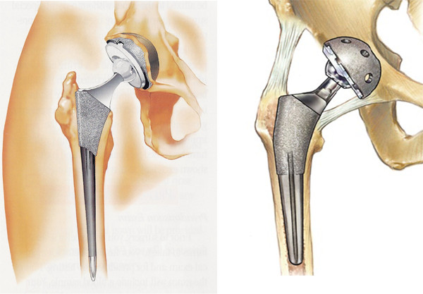 人工関節置換術(下肢)│当院の治療の特色│社会医療法人玄真堂 川嶌