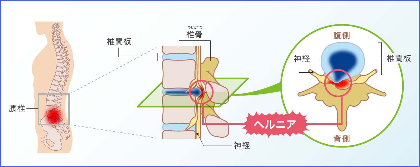 腰椎椎間板ヘルニア（ヘルニコアなど）│当院の治療の特色│社会医療