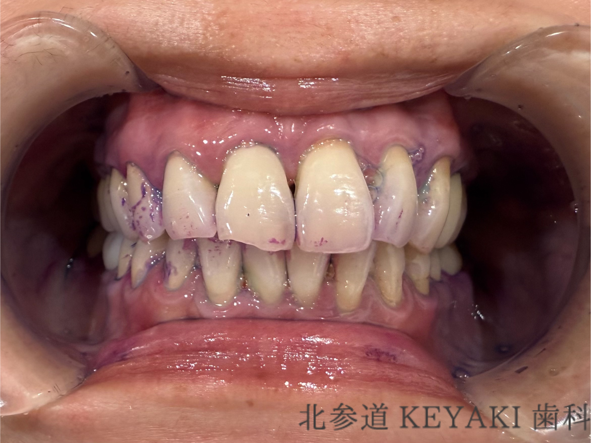 ホワイトニング ｜ 北参道の歯医者なら 北参道KEYAKI歯科｜北参道駅