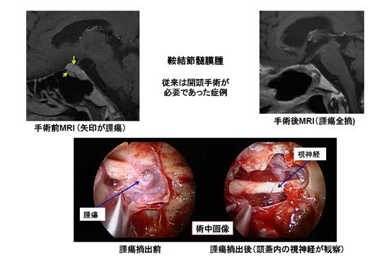 経鼻内視鏡頭蓋底手術（改訂） | KOMPAS – 慶應義塾大学病院 医療