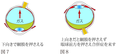さまざまな目の病気-硝子体手術について | 神戸市灘区の中川眼科医院