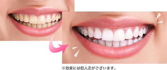 KOBEホワイトニングのセルフホワイトニング┃KOBEホワイトニング株式会社